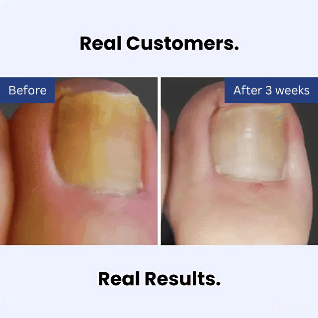 Lumavia™ Antifungal Pen