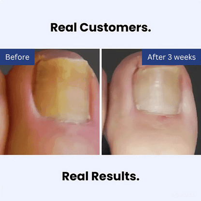 Lumavia™ Antifungal Pen